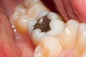 جیوه در دندانپزشکی